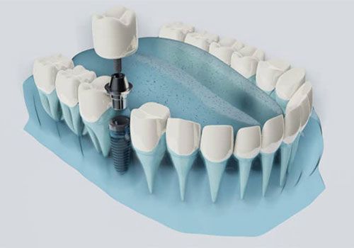 کاشت ایمپلنت دندان بدون بخیه و در کمترین زمان