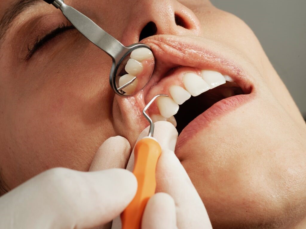 مزایا استفاده از کامپوزیت برای ترمیم دندان