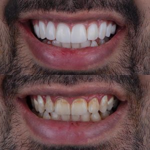مزایای لمینت دندان