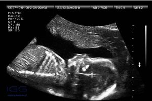 نحوه تعیین وزن جنین با سونوگرافی