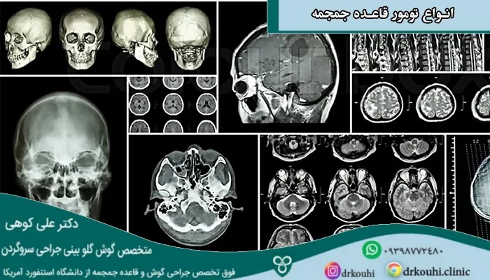 همه چیز درباره تومور قاعده جمجمه (انواع و درمان آن)