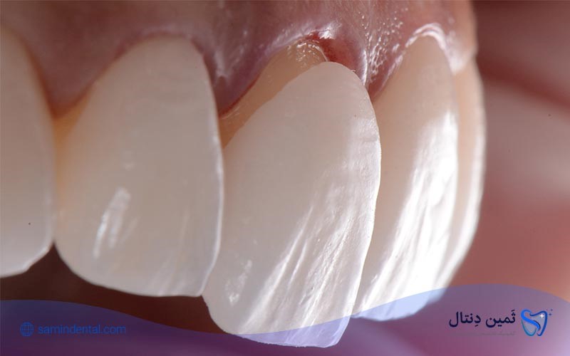 مراقبت های بعد از لمینت دندان چگونه است؟