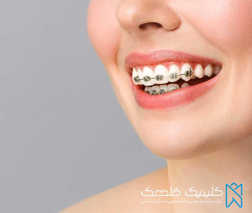 علل مختلف انجام ارتودنسی دندان