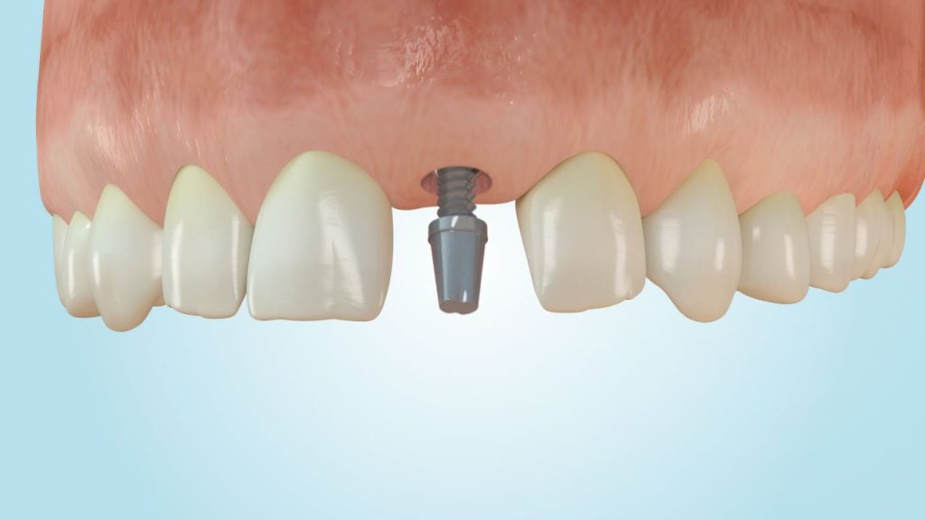عوامل موثر بر هزینه کاشت دندان جلو