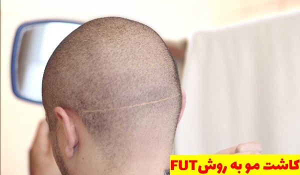  کاشت موی سر با روش FUT
