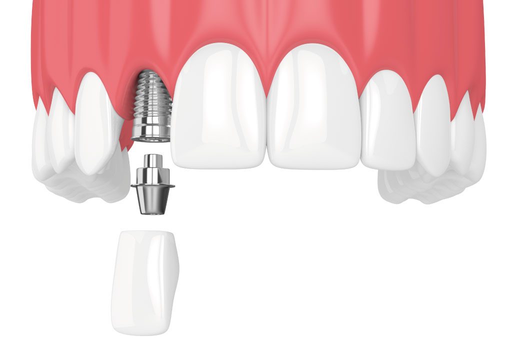 هزینه کاشت دندان جلو ( 5 توصیه مهم قبل از انجام )
