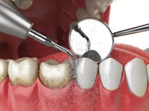پاک کردن جرم دندان در خانه (6 راهکار)پاک کردن جرم دندان در خانه (6 راهکار)