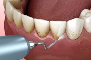 6  راهکار برای پاک کردن جرم دندان در خانه