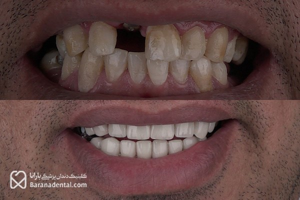 ایمپلنت، لمینت وکامپوزیت دندان محبوب‌ترین روش‌های دندانپزشکی | قیمت به روز +مراحل انجام کار
