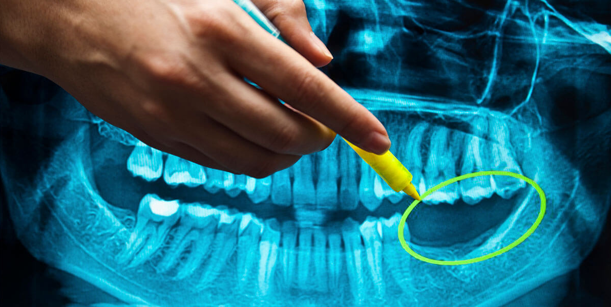 چرا ایمپلنت دندان مهم است؟
