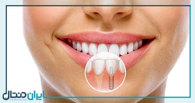 3 روش رایج کاشت ایمپلنت دندان: کدام روش مناسب است؟