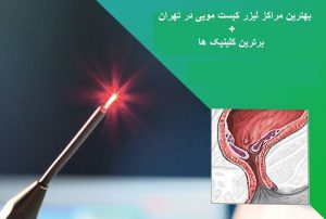 بهترین مراکز لیزر کیست مویی در تهران + معرفی 5 کلینیک برتر