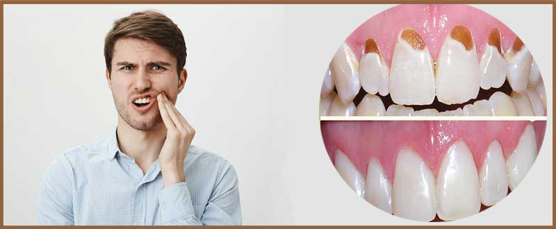 پوسیدگی دندان زیر کامپوزیت ونیر | علل + درمان