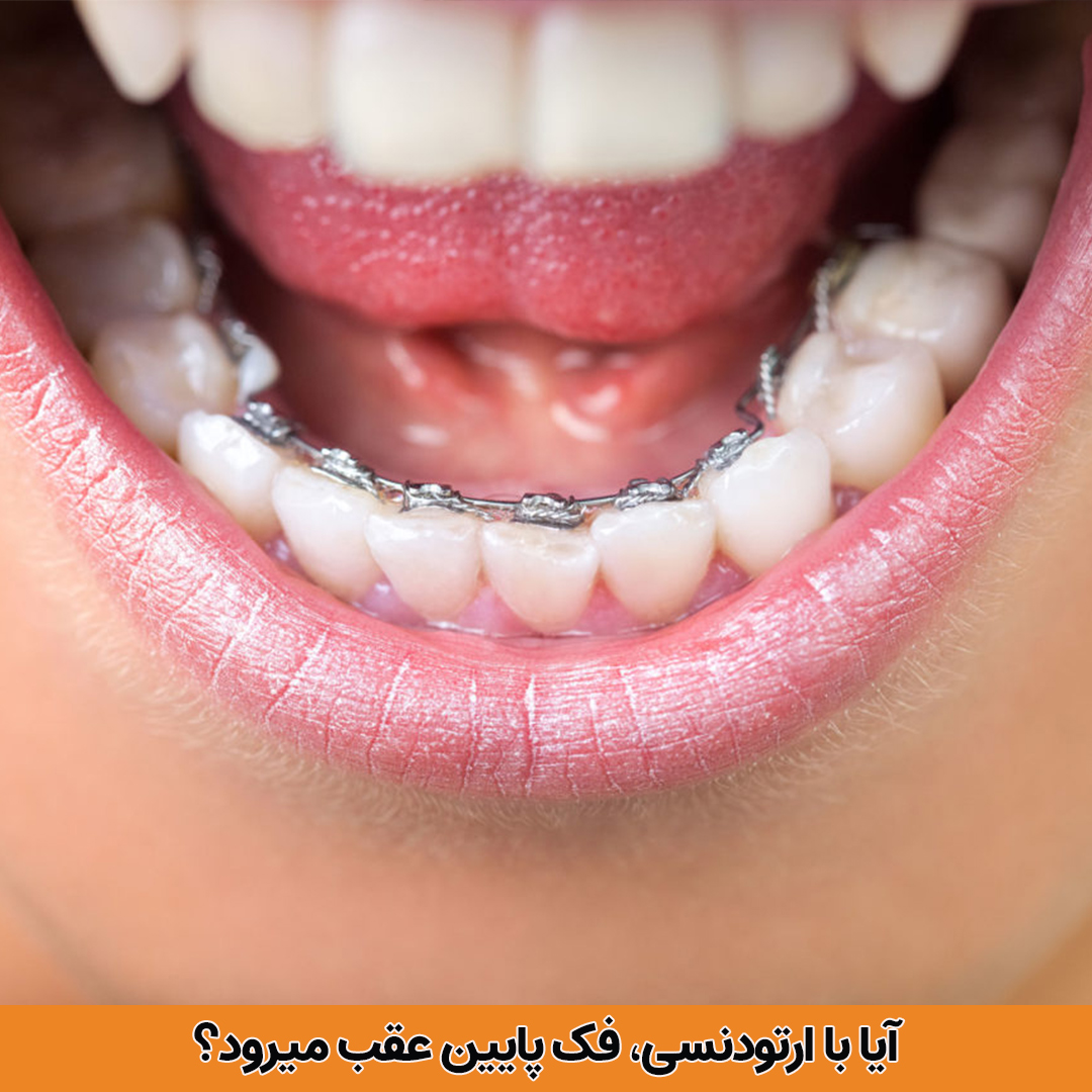 درحالی‌که می‌توانید بریس‌ها را فقط روی دندان‌های بالا یا پایین خود قرار دهید، این فقط برای برخی از بیماران مناسب است و برای اکثر افراد، ممکن است ایده‌آل‌ترین طرح درمانی نباشد.