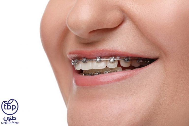 مهمترین نکات برای مراقبت از دندان ها پس از ارتودنسی